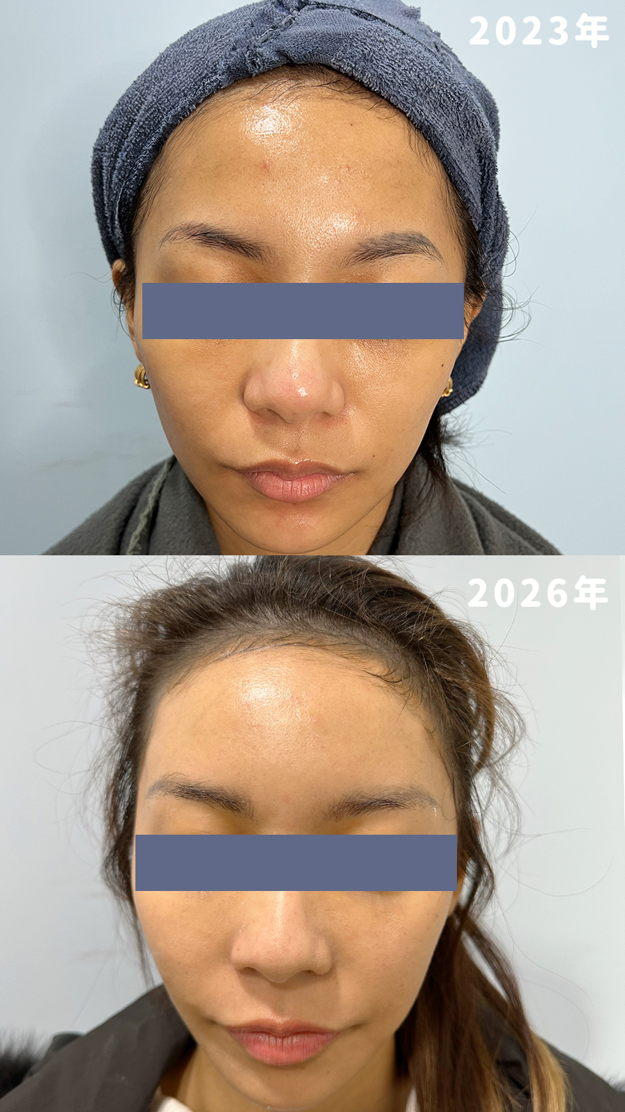 周周醫師醫美微整_額頭填充案例